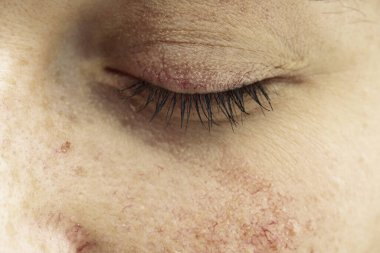 30 yaşındaki bir kızın gözünün kapalı olması, üst yanak ve göz kapağının etrafındaki kan damarlarını gösteriyor, rosacea belirtileri gösteriyor..