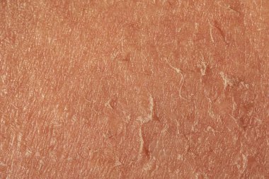 An extreme closeup view on the flaky skin of an aging caucasian person. Shedding and peeling skin fills the frame creating textured background with room for copy. clipart