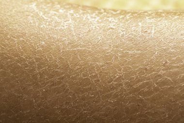 Sıcak güneşin altında nemli ve dermatologa ihtiyaç duyan çok fazla zaman geçirmekten dolayı ciddi şekilde çatlamış ve sımsıkı bir kuru cilt görüntüsü..