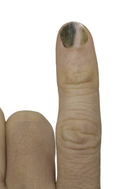 Görünür mantar enfeksiyonu olan beyaz bir zemin üzerinde izole edilmiş yetişkin bir erkeğin işaret parmağına yakın çekim görüntüsü, siyah ve koyu çizgiler ayrıntılı olarak görülür..