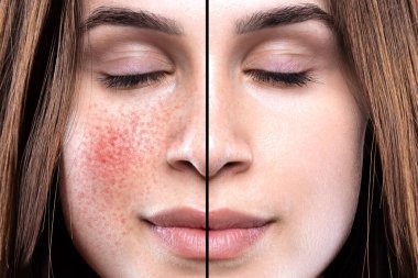 Rosacea 'dan muzdarip genç bir kızın yanaklarının öncesini ve sonuçlarını gösteren yakın plan bir portre. Yoğun ışık tedavisi semptomları başarılı bir şekilde ortadan kaldırır..