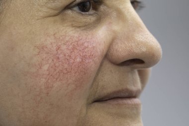 A closeup and side profile view of a mature caucasian woman, red and blotchy cheeks are seen in detail, the main symptom of rosacea, can be treated with topical creams or laser surgery. clipart