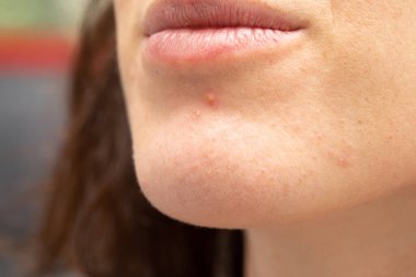 An extreme close-up view on the chin of a young Caucasian lady. Inflames pus filled spots are seen with open pores and imperfections. Infected spots similar to herpes outbreak. clipart
