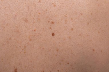 Çerçeveyi dolduran beyaz tenli benler, çiller ve sivilcelerin aşırı yakın plan görüntüsü. Cilt kanseri ve dermatoloji kavramları.