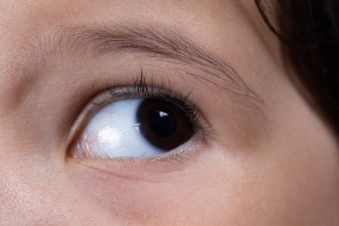 Aniridia 'dan muzdarip küçük bir çocuğun gözünde makro bir bakış. Gözde gözün bulunmadığı bir bozukluk. İris gelişiminde bozukluğa neden olan doğuştan gelen bir bozukluk..