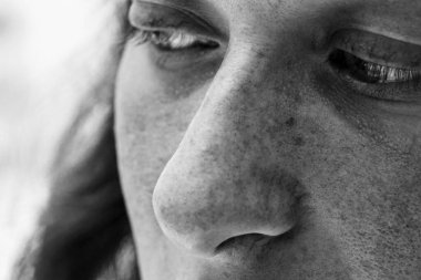 Beyaz bir bayanın yüzündeki ultraviyole hasarı gösteren tek renkli bir portre kusurlar ve benler güneş yanığı yüzünden cilt kanseri belirtileri.