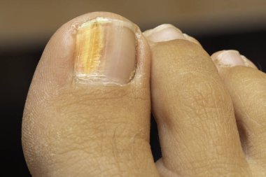 A closeup view on the foot of a person with a yellow and thick big toenail, symptoms of Onychomycosis, a common fungal infection commonly found in toe nails. clipart