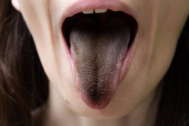 Siyah kıllı dilli (enterobacter cloacae) bir kızın yakın plan görüntüsü. Ağızda bakteriyel enfeksiyonun yaygın bir belirtisi..