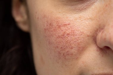 Yanağında küçük, yüzeysel, genişlemiş kan damarları olan beyaz bir kızın yüzüne yakından bakmak. Rosacea 'nın yaygın bir semptomu hastayı yüzünde kızarıklık yapıyor gibi gösterir..