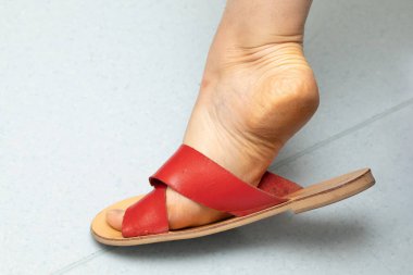 Kadın ayağı, nasırlardan dolayı kalınlaşmış deriyle topuk gösteriyor.