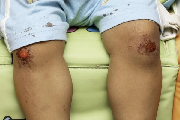 Childish Knee Abrasion Kid Injury Close — Stock Photo, Image