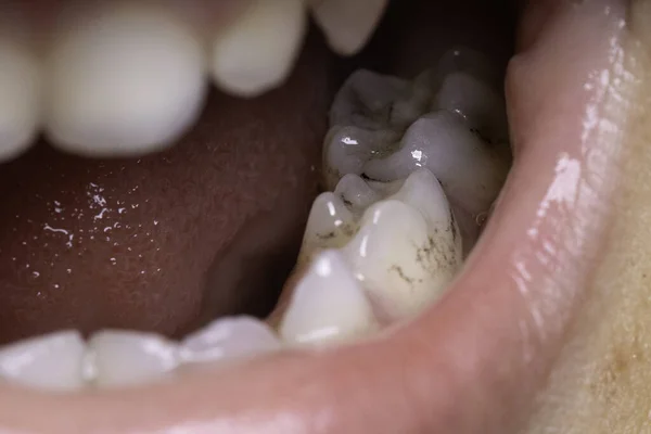 Decadência Dentária Humana Placa Cárie Perto — Fotografia de Stock