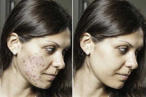 A young woman with brunette hair shows the before and after results of successful acne treatment, spots and scars have been removed through the application of prescribed topical creams.