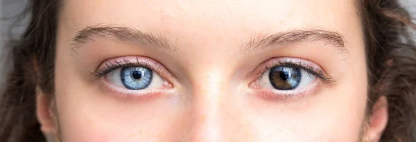 Heterocromia Humana Los Ojos Niña Azul Marrón —  Fotos de Stock