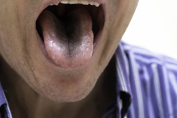 Eine Nahaufnahme Und Frontansicht Auf Der Zunge Eines Älteren Mannes — Stockfoto