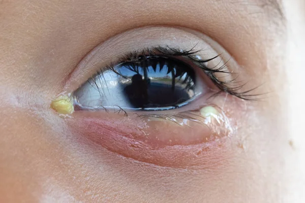 A close up and front view on the eye of a preschool child suffering from bacterial conjunctivitis, causing teary eyes and weeping crusty pus, fighting infection.