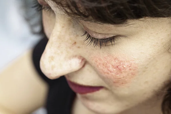 Close Visão Alto Ângulo Uma Mulher Bonita Que Sofre Vermelhidão — Fotografia de Stock