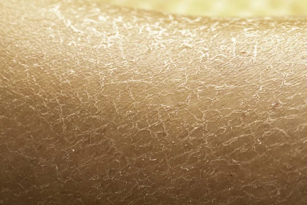 对干燥皮肤的特写 由于在炎热的阳光下呆的时间太长 需要水分和皮肤科医生 导致皮肤严重开裂和紧绷 — 图库照片