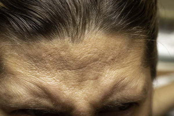 Closeup Detailed View Forehead Frowning Woman Wrinkles Seen Caused Stress — Stock Photo, Image