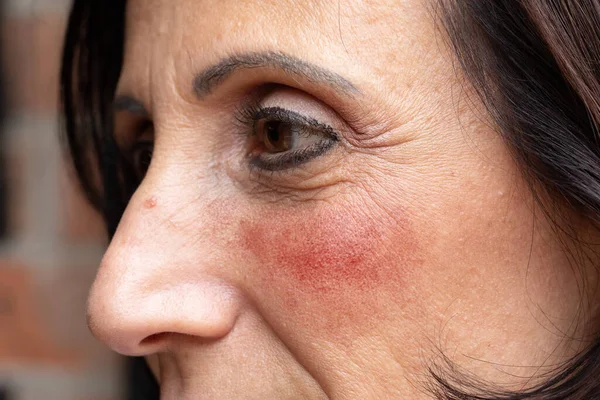 Yaşlarda Gül Kırmızısı Yanaklardan Muzdarip Rosacea Nın Belirtilerinden Muzdarip Olgun — Stok fotoğraf