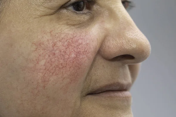 Olgun, beyaz tenli bir kadının yakın çekim ve yan profil görüntüsü, kırmızı ve lekeli yanaklar ayrıntılı olarak görülür, Rosacea 'nın ana belirtileri, topikal kremler veya lazer cerrahi ile tedavi edilebilir..