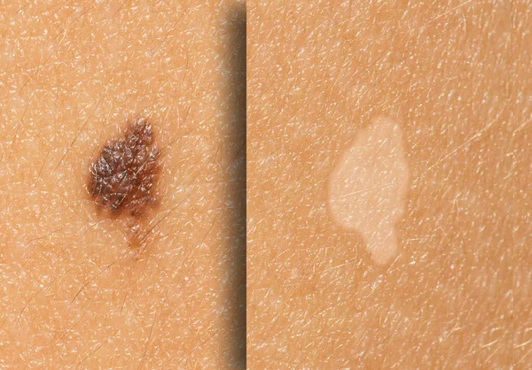 Zblízka Před Pohledu Odstranění Krtka Kůže Výsledky Úspěšné Operaci Odstranit — Stock fotografie