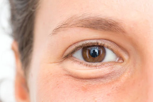 Close up view on the swollen and puffy eye of a female causing eye bag, symptom of stress and tiredness in a busy adult lifestyle