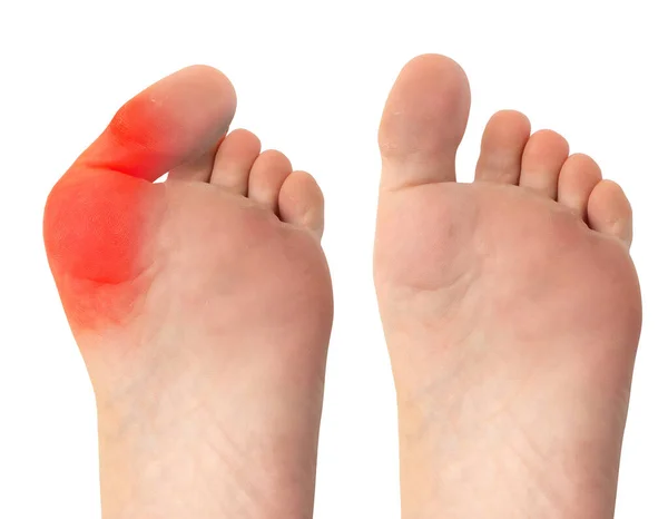 View Successful Surgery Remove Severe Bunion Foot Caucasian Person Image — Stock Photo, Image