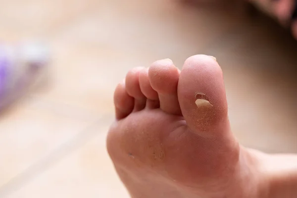 Broken bladder in a dehydrated female foot with dry skin