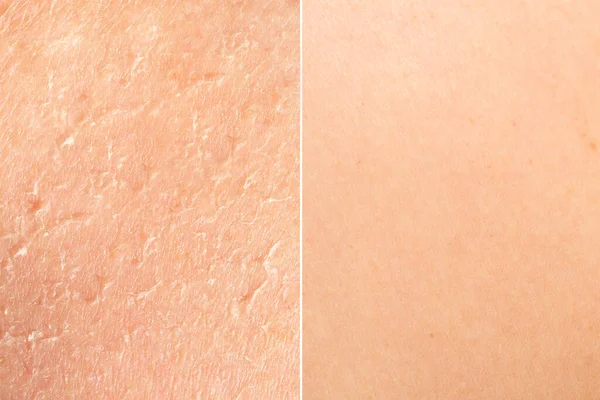 皮膚科治療前と後の完璧な若い肌に対して傷や傷を示す人間の皮膚の側面の比較 — ストック写真