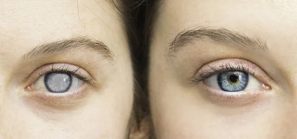 Persona Con Pupilo Blanco Comparación Ojos Sanos Cerca —  Fotos de Stock