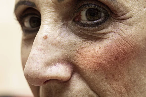 Närbild Mogen Kvinnas Åldrande Ansiktshud Femtioårsåldern Med Röda Rodnande Kinder — Stockfoto
