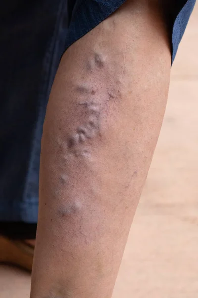A severe case of varicose veins is seen in the leg of an older Caucasian person. A close up view on the superficial veins which have enlarged and twisted just beneath the skin.