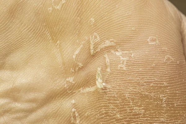 Extrémní Detailní Pohled Kalenou Mozolnatou Pokožku Zbavující Mozoly Místě Starého — Stock fotografie