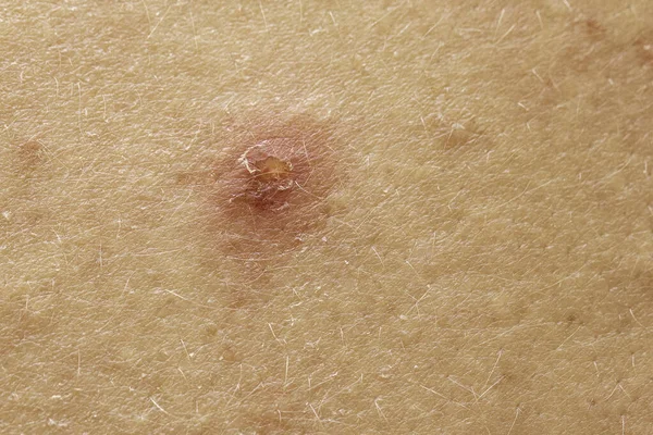 Crosta Rasgada Pele Dermatite Perto — Fotografia de Stock
