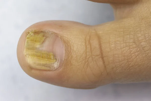 A closeup view on the big toe nail of a caucasian adult, brittle and thickened with yellow discoloration, symptomatic of tinea unguium, a common fungal infection.