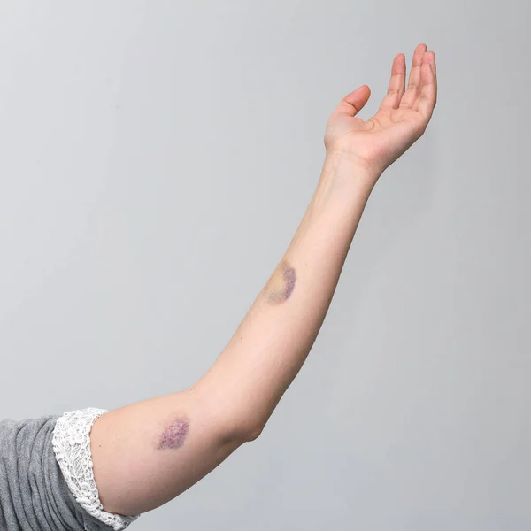 How Remove Bruises — Stock Photo, Image