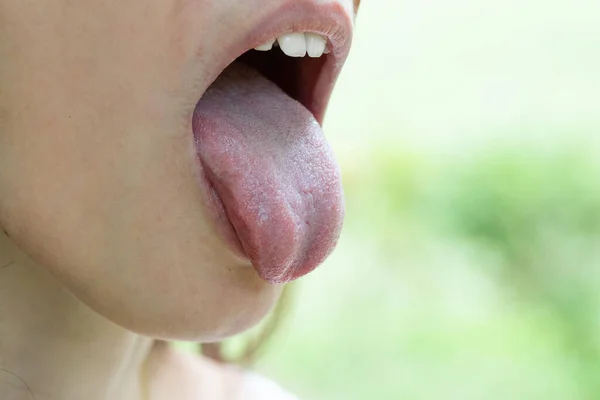 Nahaufnahme Einer Zunge Aus Dem Mund Konzept Des Mundgeruchsproblems — Stockfoto
