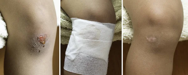 Tratamiento Herida Rodilla Etapas Cicatrización Cerca — Foto de Stock