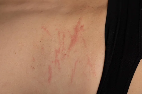 Close up view of skin with red scratches