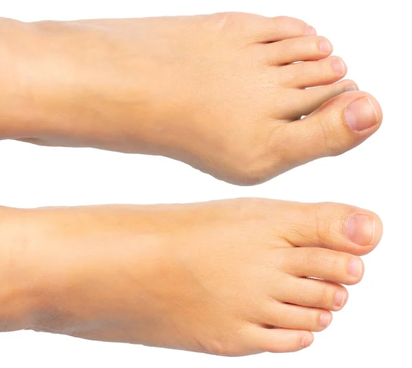 一个被白色背景隔离的高加索人的脚痛和疼痛的特写 大脚趾边缘的浮肿会导致畸形 — 图库照片