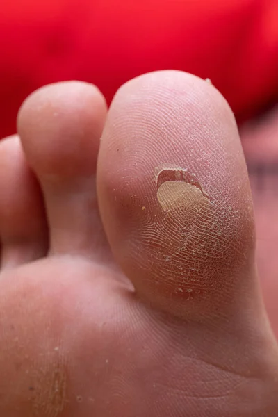 Large callus cracked in the big toe of a woman's foot