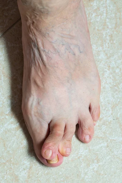 Nahaufnahme Fuß Einer Älteren Frau Die Einem Extremen Hallux Valgus — Stockfoto