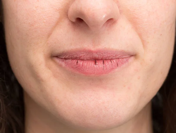 Une Vue Rapprochée Sur Les Lèvres Sèches Fissurées Une Femme — Photo