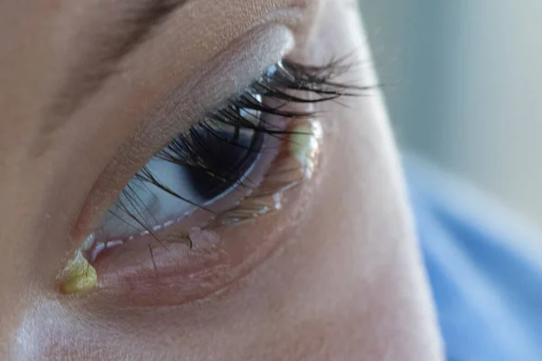 Vedere Aproape Ochiul Unui Copil Mic Infecție Bacteriană Provocând Descărcare — Fotografie, imagine de stoc