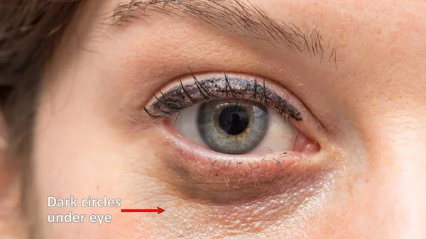 A close up view on the green eye of a pretty young Caucasian woman. Dark circles caused by fatigue and stress are seen underneath the eyes.