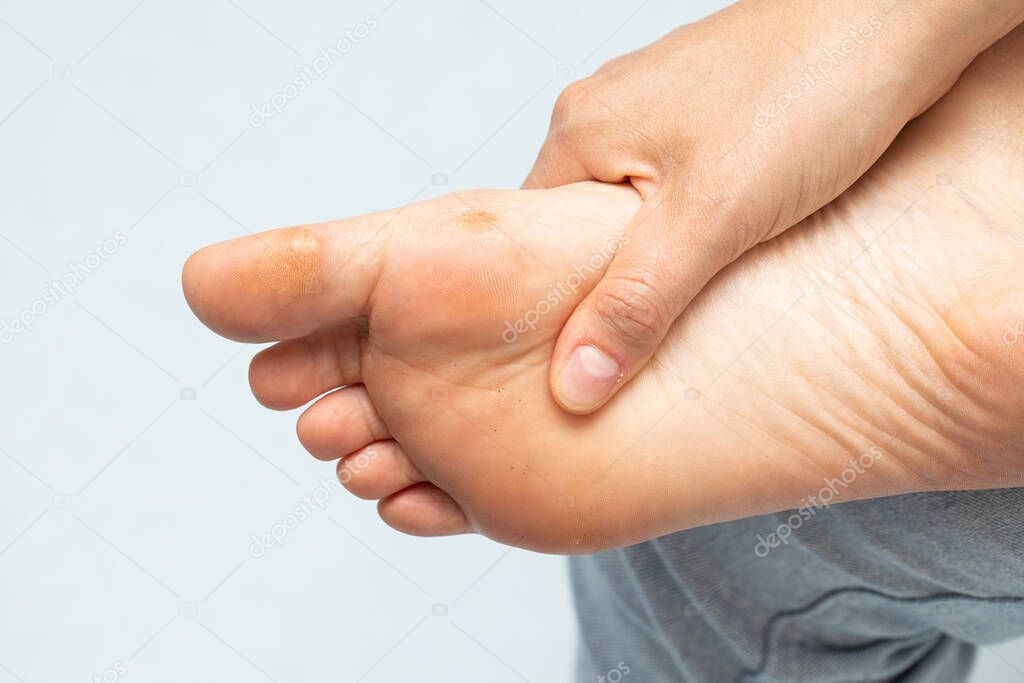 Female hand tightening its foot with calluses and warts