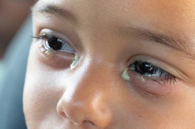 Genç bir çocuk, viral konjonktivit enfeksiyonundan rahatsız ve acı çekiyor gibi görünüyor. İltihap boşalması ve şişmiş göz kapaklarıyla, kırmızı ve kabarık..