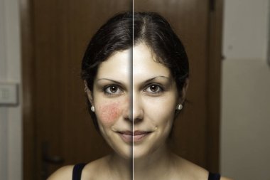 Kendinden emin genç bir kadın, Rosacea 'nın başarılı tedavisinin öncesi ve sonrasını gösteriyor. Kırmızı ve lekeli yanaklar lazer ameliyatıyla çıkarıldı..