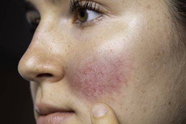 A young caucasian woman is seen closeup and from the side, pointing towards her red flushing cheek with blotches and dilated blood vessels, al symptomatic of rosacea clipart